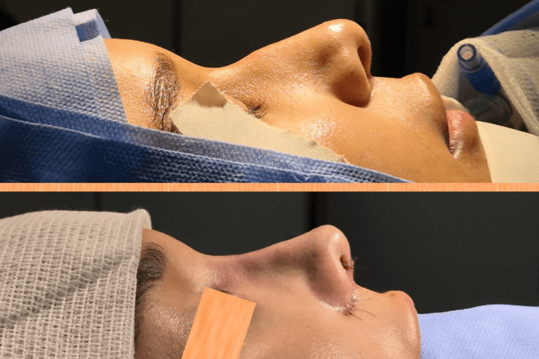Rinoplastia realizada pela dra. Danielle Repsold